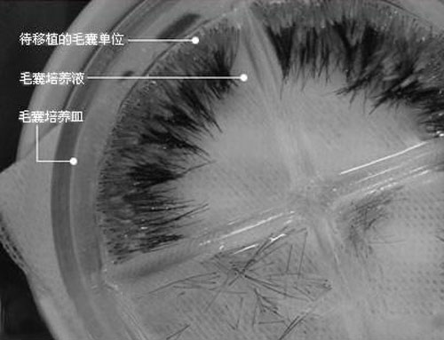 植发流程：分离毛囊培养