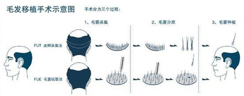 植发流程：毛发移植