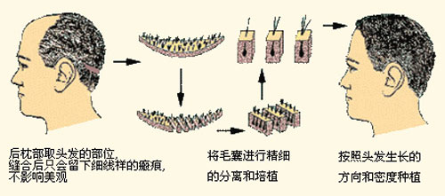 植发原理