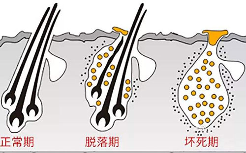 植发问题