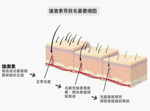 怎么治疗脂溢性脱发