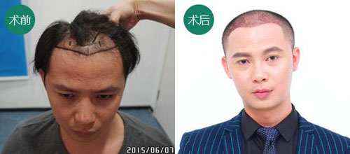 广州植发医生杨晓谈头发种植,头发不是你想植就能植的