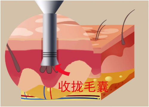 瑞士NAT美学植发技术