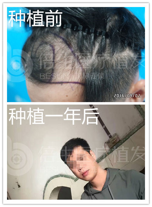 瑞士NAT美学植发技术