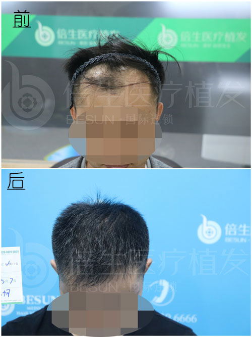 种植头发