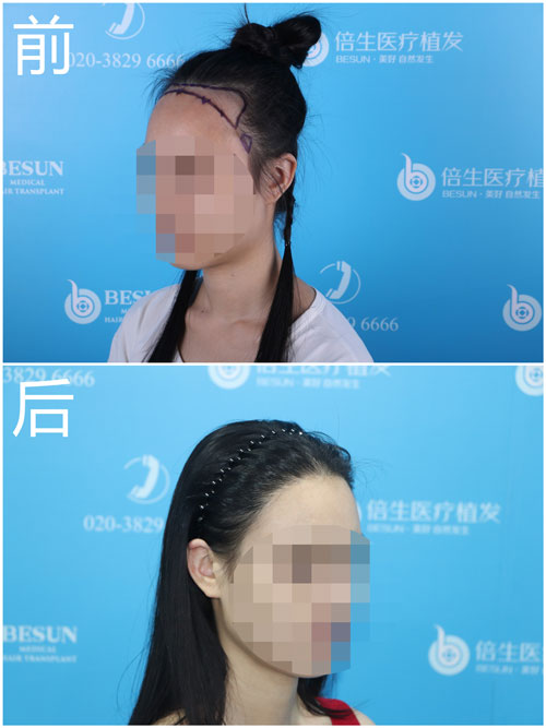 倍生植发