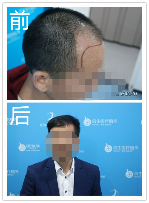 瑞士NAT美学植发技术