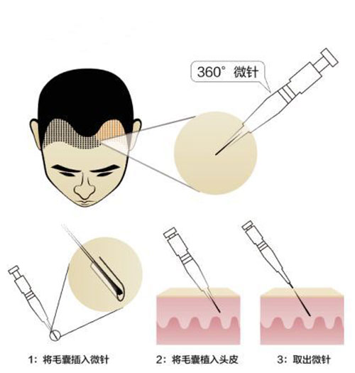 SEP超级微针植发