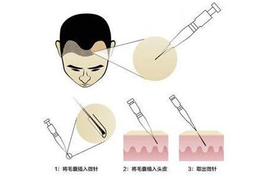 SEP超级微针植发